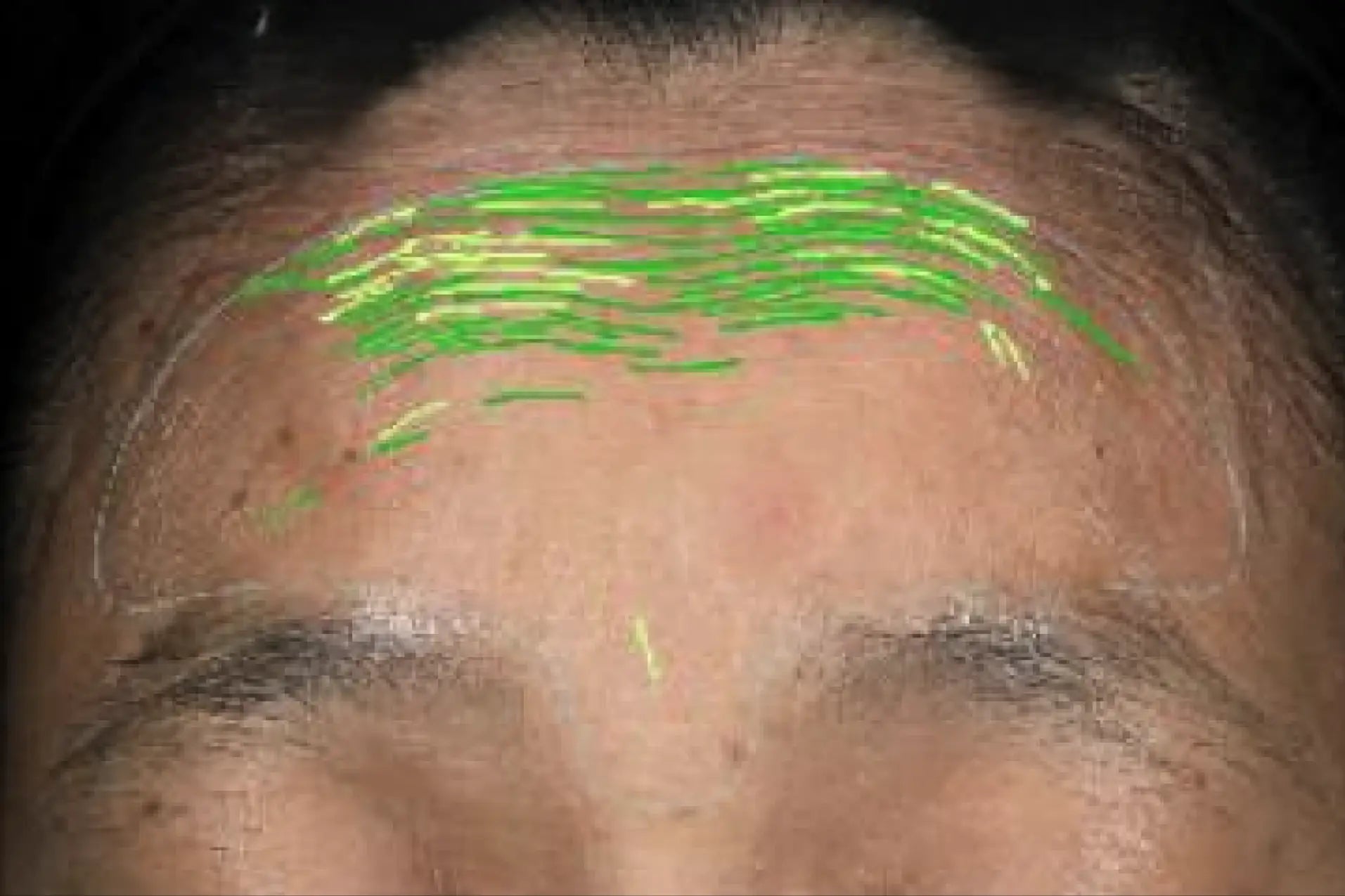 theBeam before and after for forehead lines