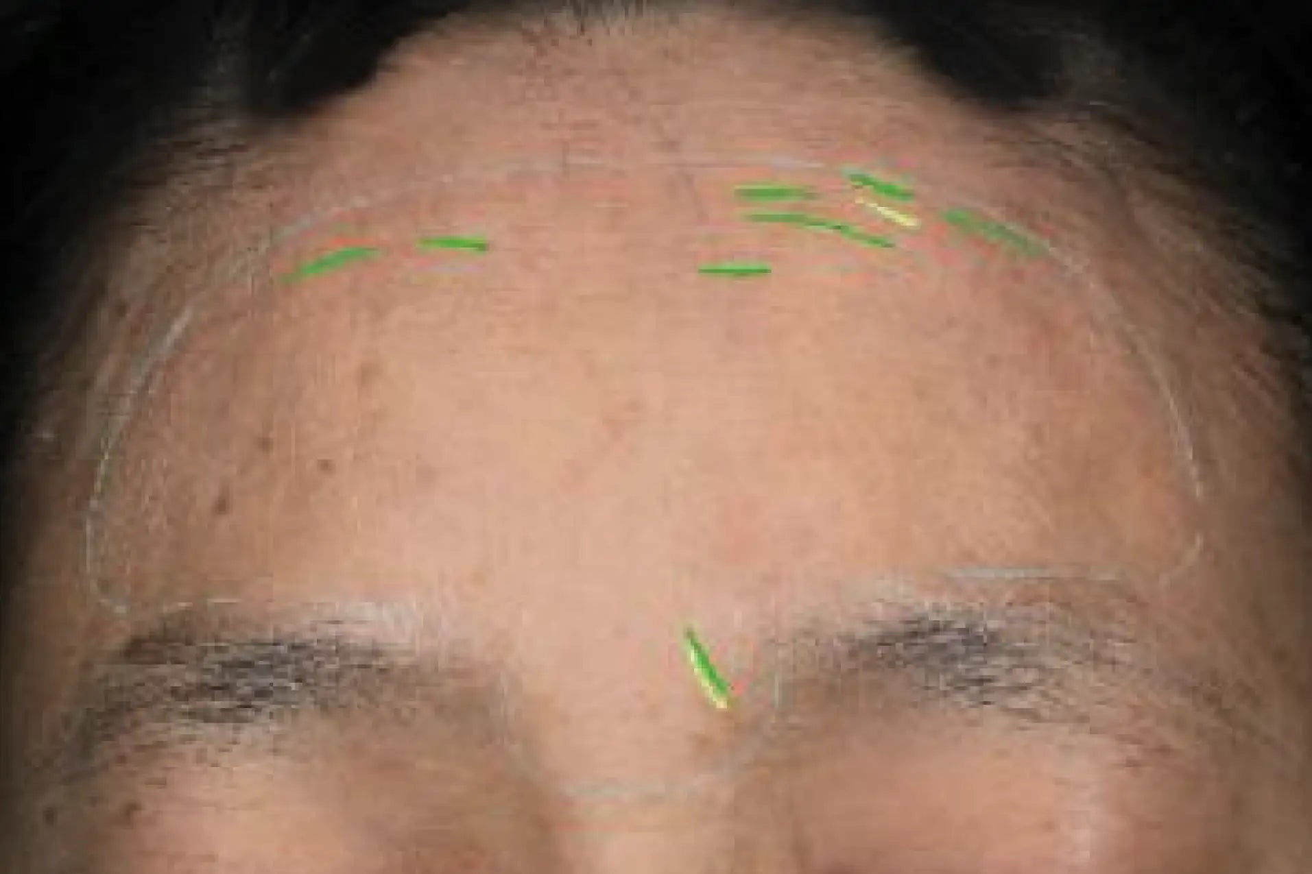 theBeam before and after for forehead lines