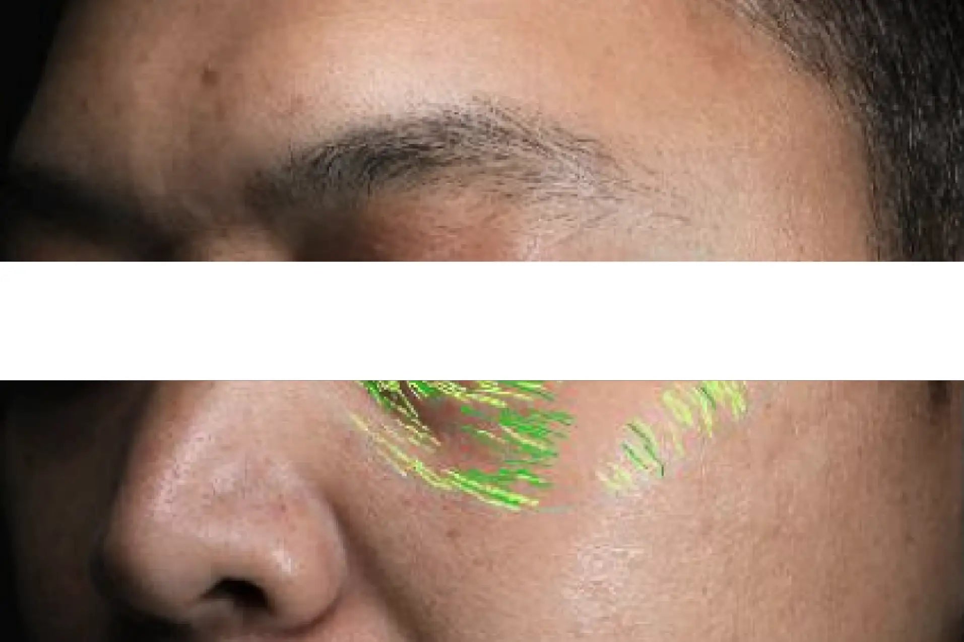 theBeam before and after for Eye wrinkles
