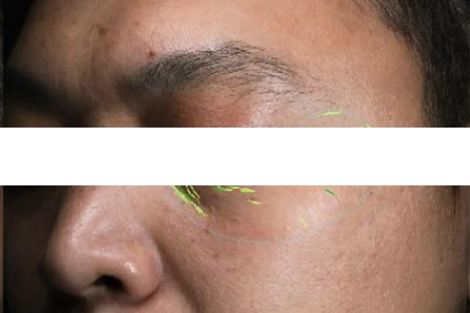 theBeam before and after for Eye wrinkles