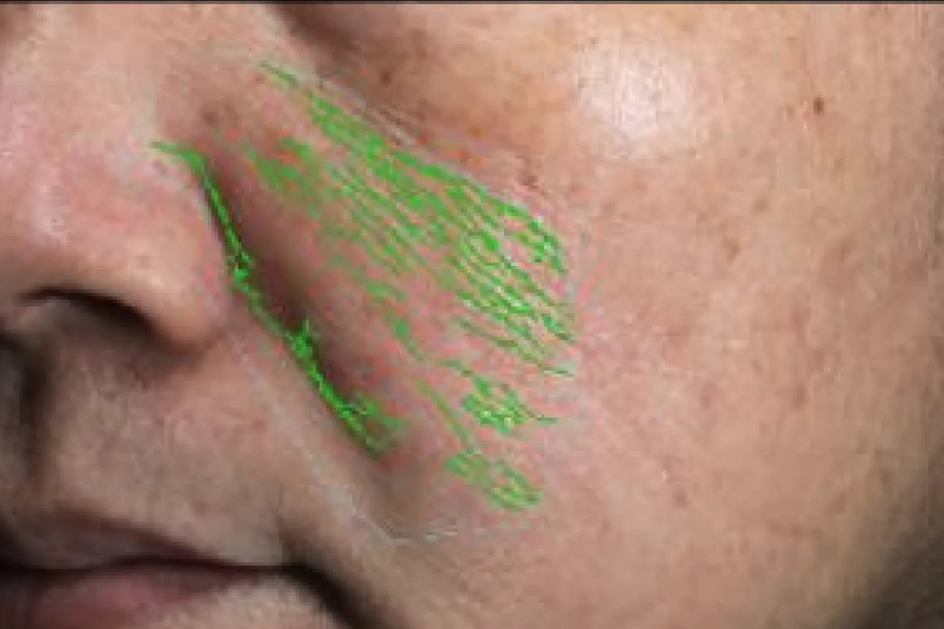 theBeam before and after for Smile lines