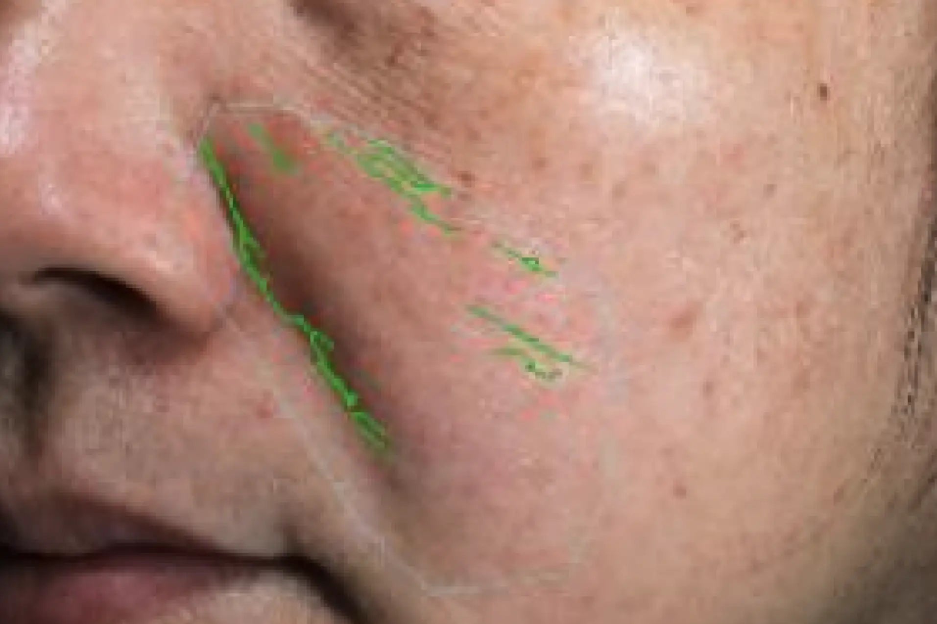 theBeam before and after for Smile lines