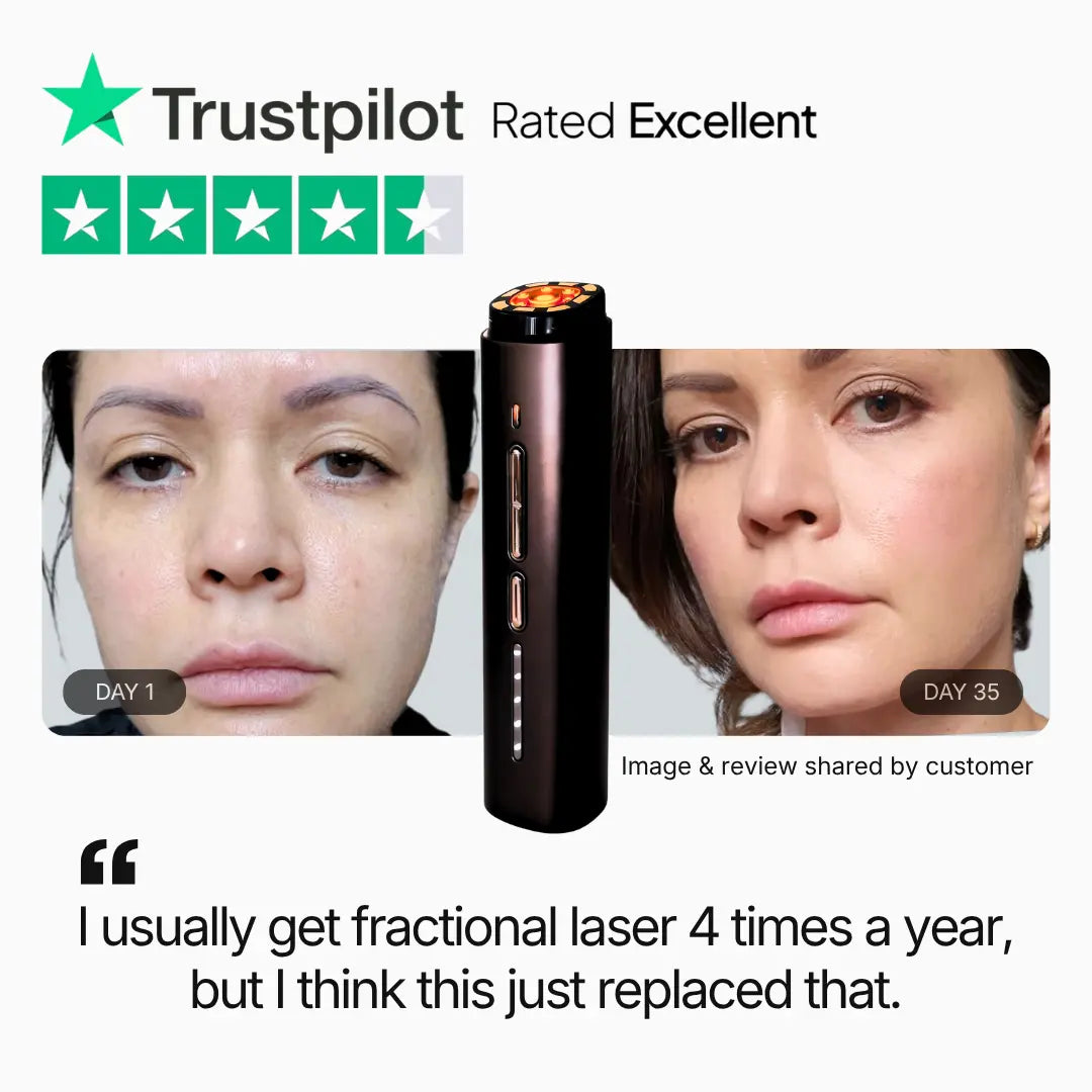 theBeam Renew Frequency RF skin device shown with a Trustpilot 'Rated Excellent' banner and customer-submitted photos labelled Day 1 and Day 35