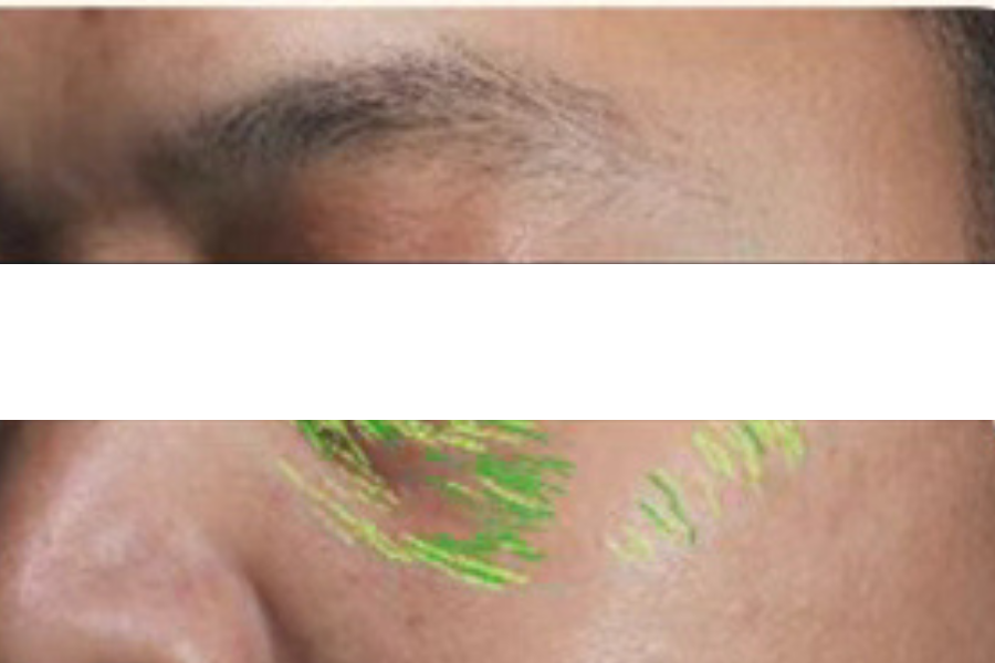 theBeam before and after for eye wrinkles