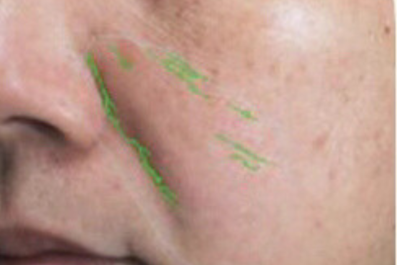 theBeam before and after for smile lines