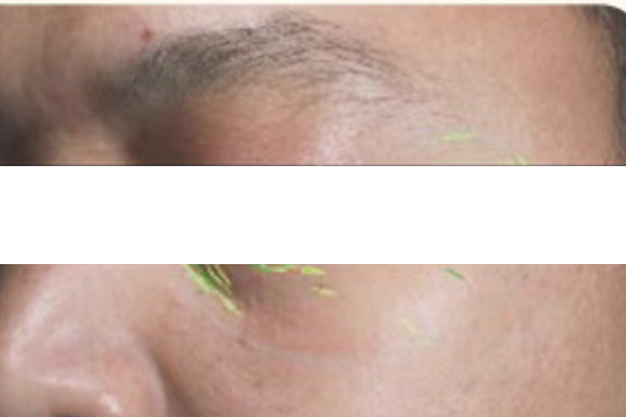 theBeam before and after for eye wrinkles