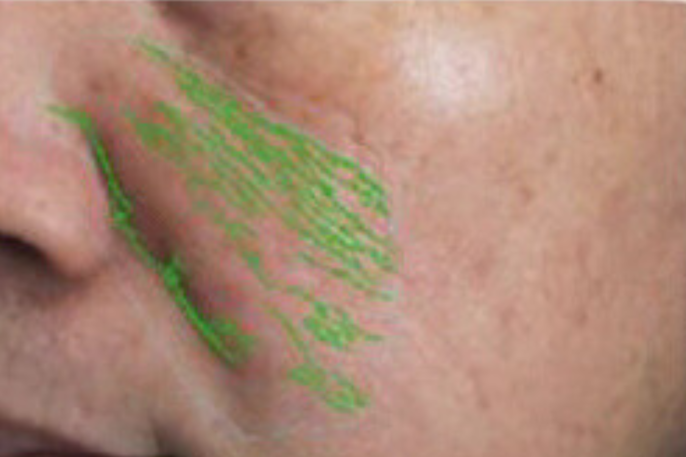 theBeam before and after for smile lines