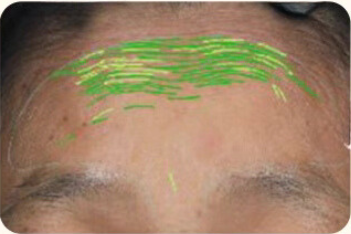 theBeam before and after for forehead lines