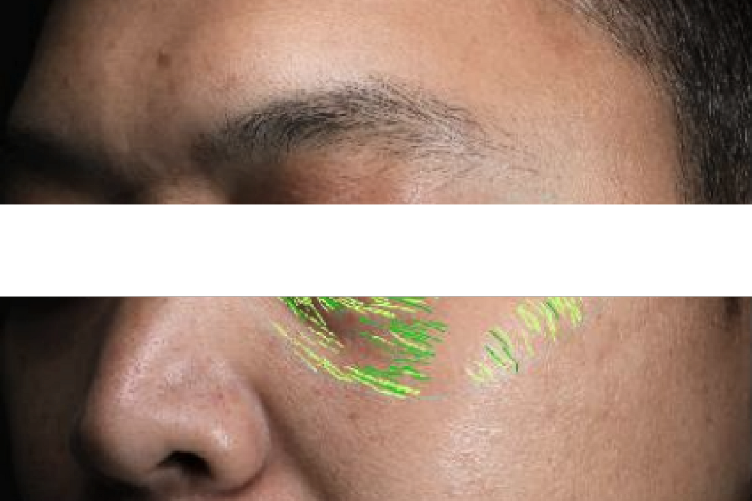 theBeam before and after for forehead lines